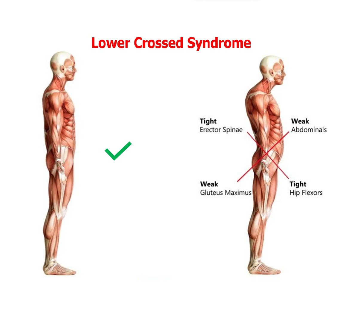 lower crossed synd