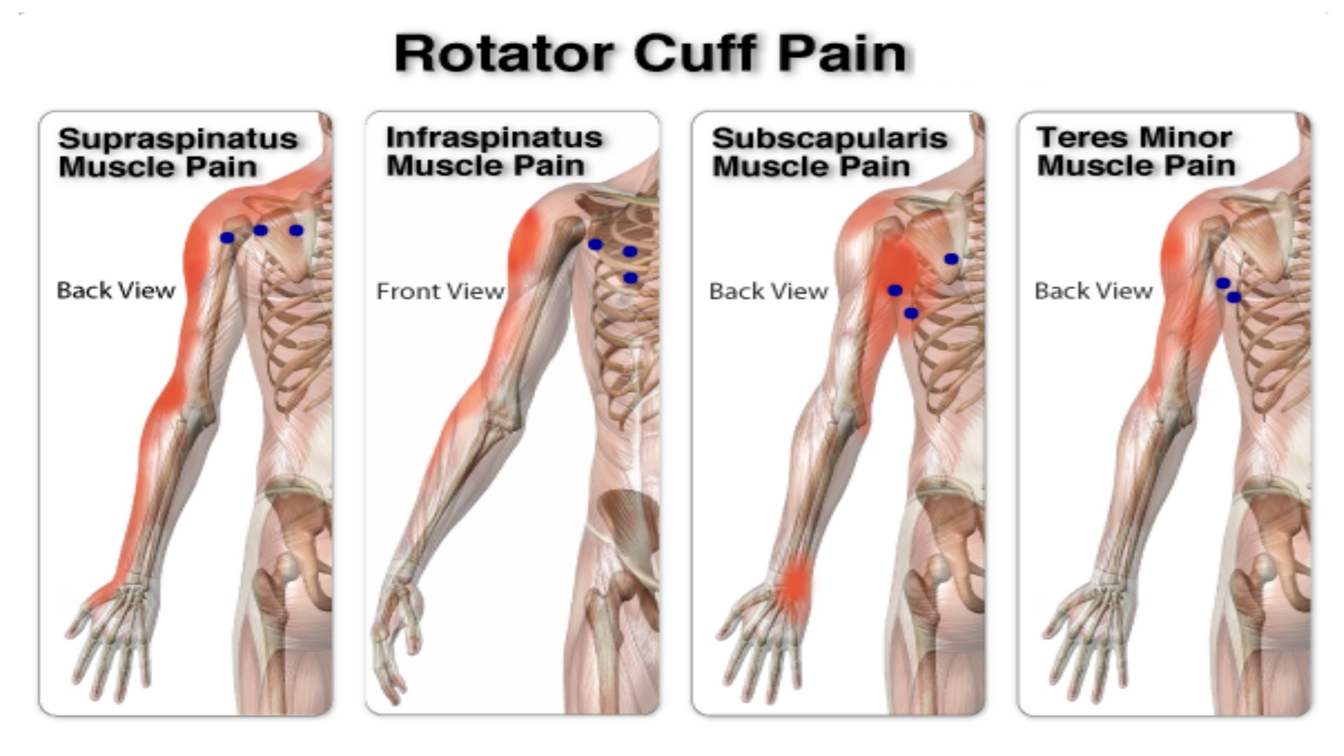 rotator cuff pain