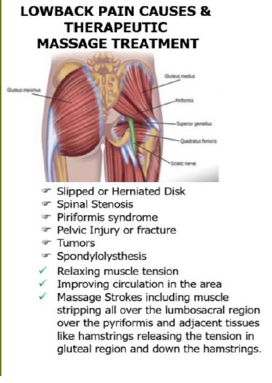 sciatica pain