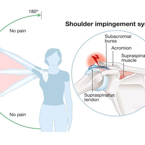 PAINFUL IMPINGMENT